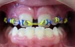 Braces & Expansions - During