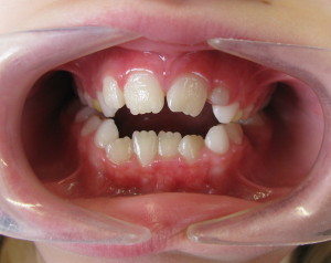 Open Bite Teeth Treatment St. Charles
