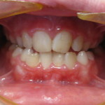 Open Bite Teeth Treatment Chesterfield