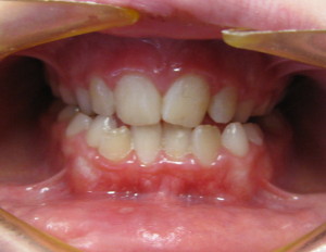 Open Bite Teeth Treatment Chesterfield
