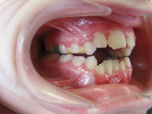 Open Bite Orthodontics