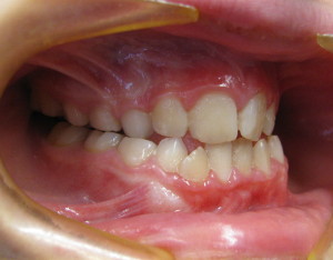 Open Bite Teeth Orthodontist